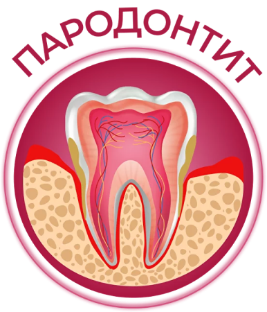 paradontoz
